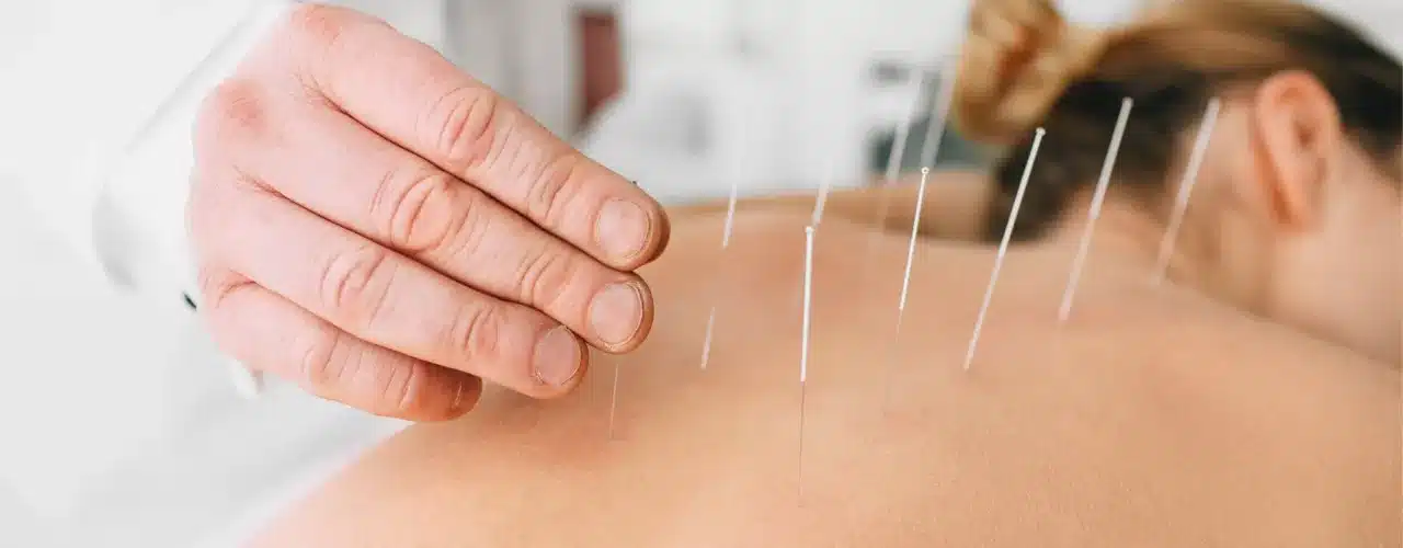 Acupuncture pour maigrir